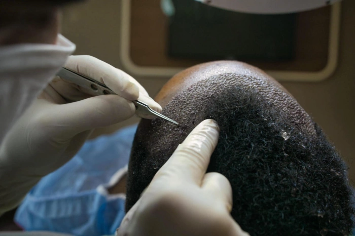 afro hair transplant black men