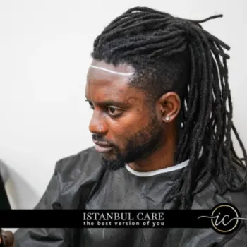 afro hair transplant turkey black men