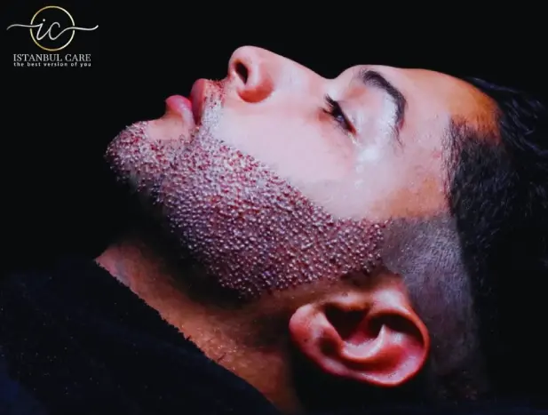 Beard Transplant in Turkey