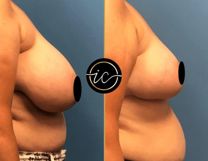 breast reduction turkey istanbul-care