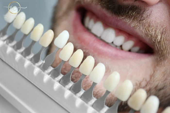 how much are emax veneers in turkey