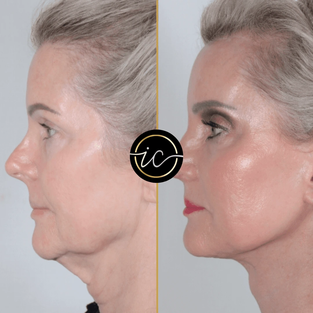 facelifting-in-turkey Facelifting in Turkey