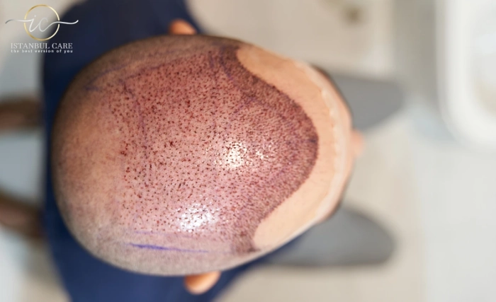 fue-technique-hair-transplant-in-turkey fue hair transplant turkey