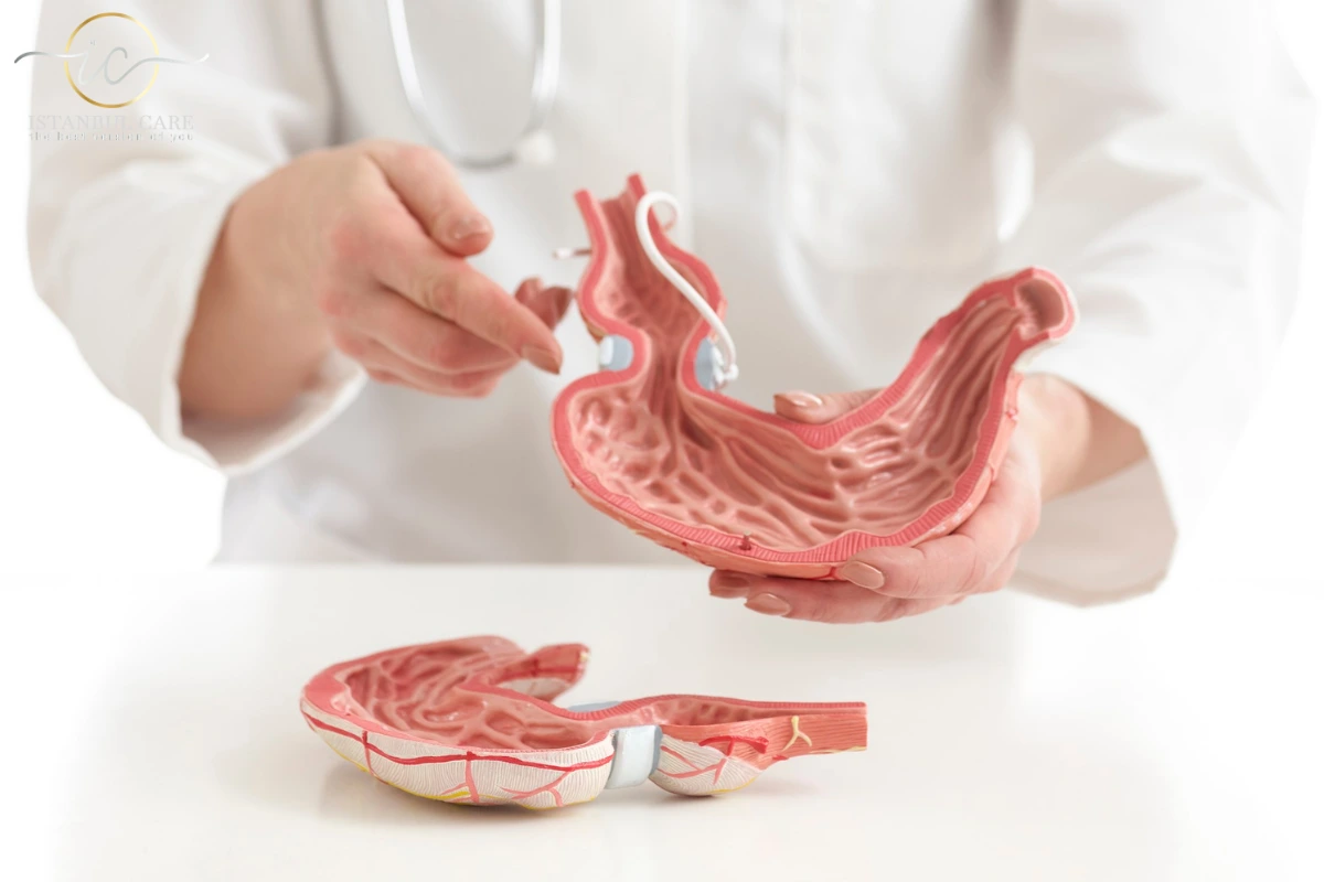 Gastric Band