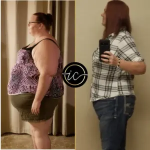 gastric bypass surgery before after