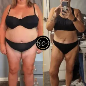 gastric bypass surgery turkey