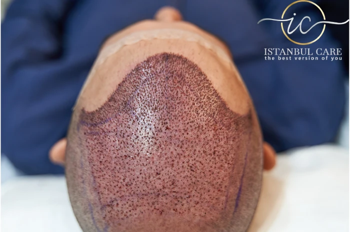 hairline hair transplant turkey