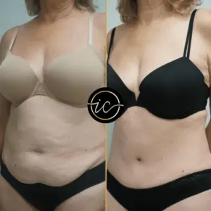 mega liposuction turkey befor after