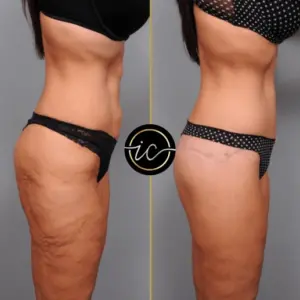 mega liposuction turkey istanbul-care