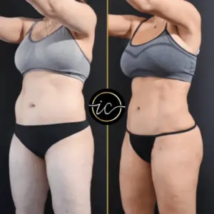 mega liposuction turkey