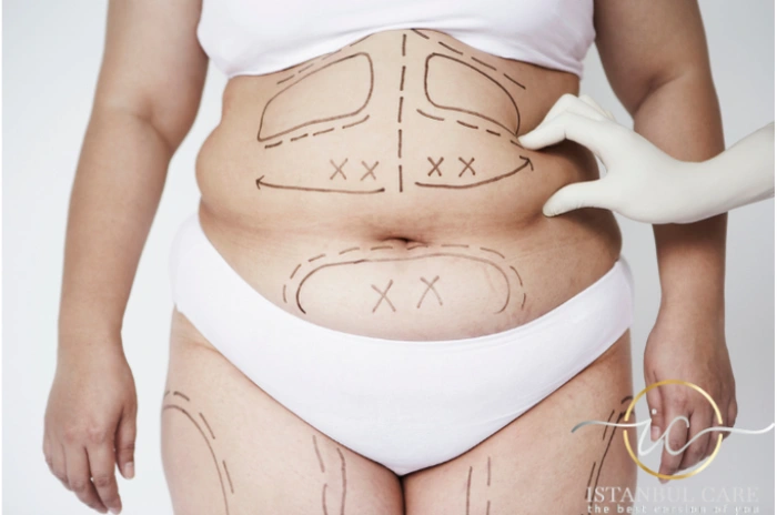 Mega Liposuction in Turkey