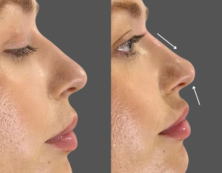 rhinoplasty turkey istanbul-care