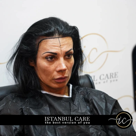 Woman Hair Transplant in Turkey